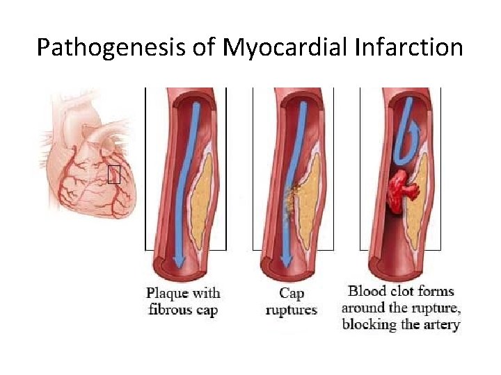 Pathogenesis of Myocardial Infarction 