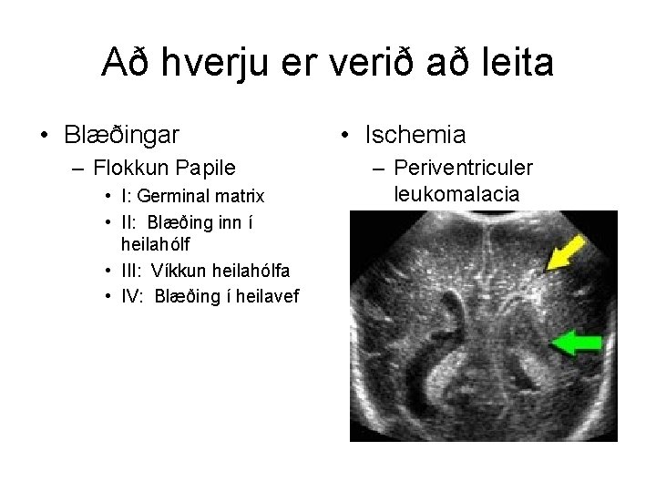 Að hverju er verið að leita • Blæðingar – Flokkun Papile • I: Germinal