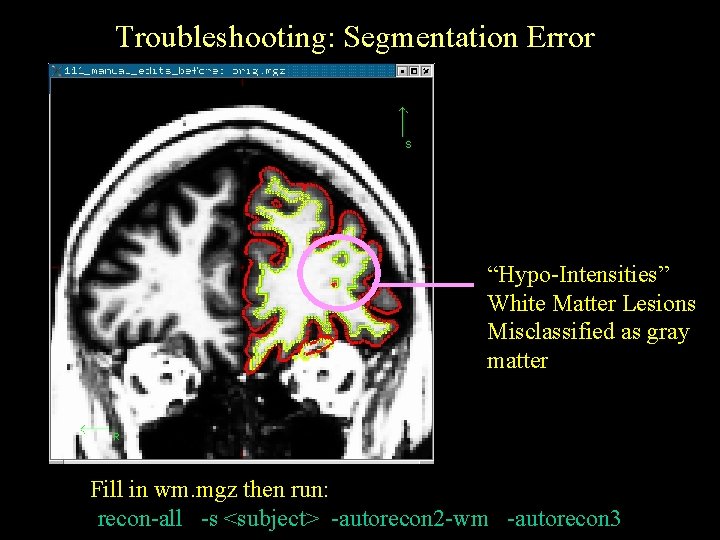 Troubleshooting: Segmentation Error “Hypo-Intensities” White Matter Lesions Misclassified as gray matter Fill in wm.