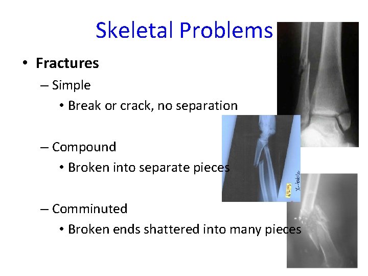 Skeletal Problems • Fractures – Simple • Break or crack, no separation – Compound