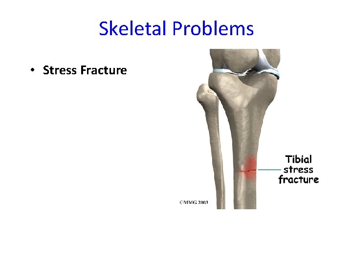 Skeletal Problems • Stress Fracture 