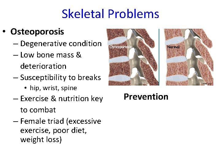 Skeletal Problems • Osteoporosis – Degenerative condition – Low bone mass & deterioration –