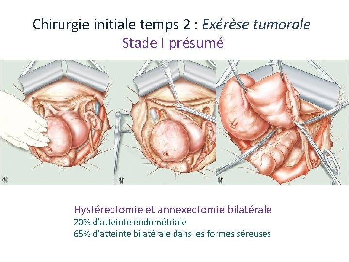 Chirurgie initiale temps 2 : Exérèse tumorale Stade I présumé Hystérectomie et annexectomie bilatérale Chirurgie initiale temps 2 : Exérèse tumorale Stade I présumé Hystérectomie et annexectomie bilatérale