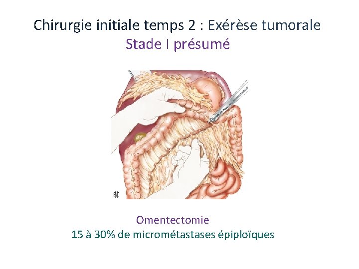 Chirurgie initiale temps 2 : Exérèse tumorale Stade I présumé Omentectomie 15 à 30% Chirurgie initiale temps 2 : Exérèse tumorale Stade I présumé Omentectomie 15 à 30%
