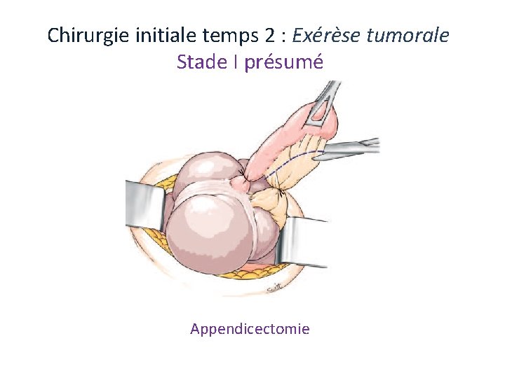 Chirurgie initiale temps 2 : Exérèse tumorale Stade I présumé Appendicectomie Chirurgie initiale temps 2 : Exérèse tumorale Stade I présumé Appendicectomie