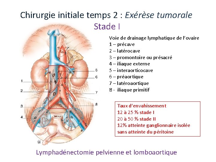 Chirurgie initiale temps 2 : Exérèse tumorale Stade I Voie de drainage lymphatique de Chirurgie initiale temps 2 : Exérèse tumorale Stade I Voie de drainage lymphatique de