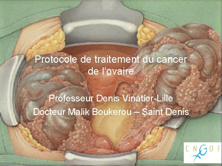 Protocole de traitement du cancer de l’ovaire Professeur Denis Vinatier-Lille Docteur Malik Boukerou – Protocole de traitement du cancer de l’ovaire Professeur Denis Vinatier-Lille Docteur Malik Boukerou –