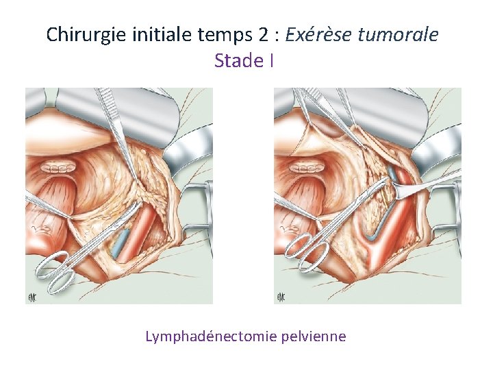 Chirurgie initiale temps 2 : Exérèse tumorale Stade I Lymphadénectomie pelvienne Chirurgie initiale temps 2 : Exérèse tumorale Stade I Lymphadénectomie pelvienne