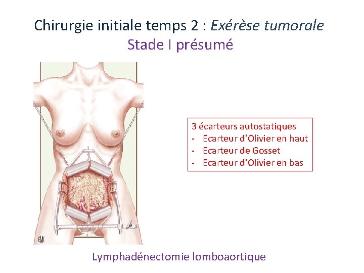 Chirurgie initiale temps 2 : Exérèse tumorale Stade I présumé 3 écarteurs autostatiques ‐ Chirurgie initiale temps 2 : Exérèse tumorale Stade I présumé 3 écarteurs autostatiques ‐