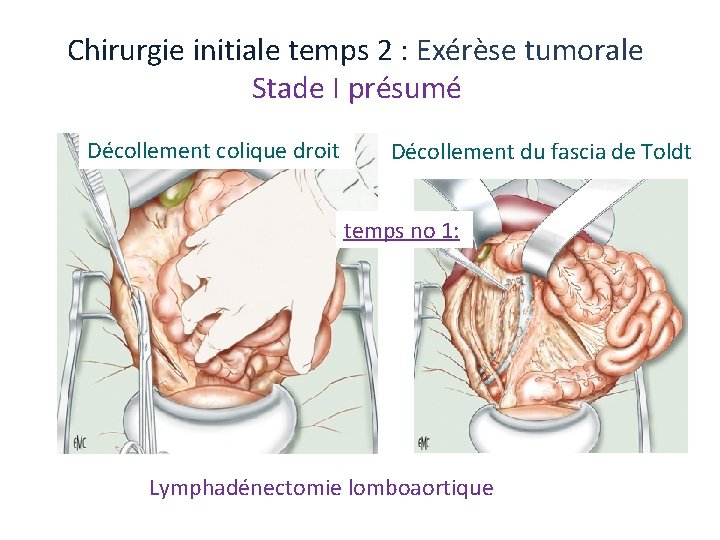 Chirurgie initiale temps 2 : Exérèse tumorale Stade I présumé Décollement colique droit Décollement Chirurgie initiale temps 2 : Exérèse tumorale Stade I présumé Décollement colique droit Décollement