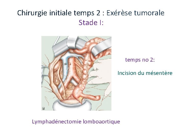 Chirurgie initiale temps 2 : Exérèse tumorale Stade I: temps no 2: Incision du Chirurgie initiale temps 2 : Exérèse tumorale Stade I: temps no 2: Incision du