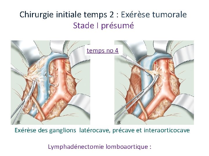 Chirurgie initiale temps 2 : Exérèse tumorale Stade I présumé temps no 4 Exérèse Chirurgie initiale temps 2 : Exérèse tumorale Stade I présumé temps no 4 Exérèse