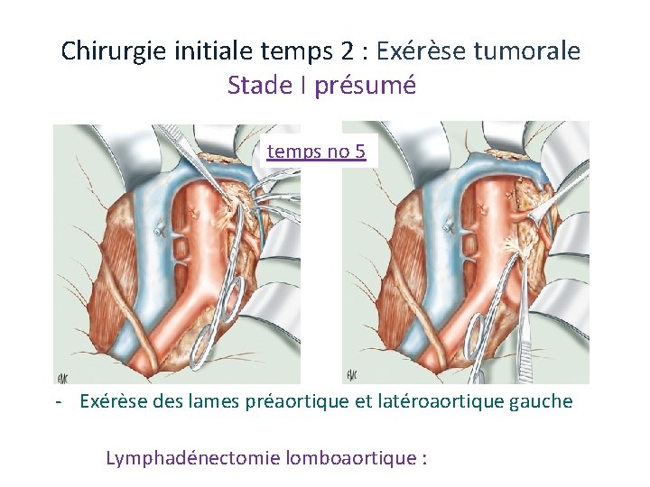 Chirurgie initiale temps 2 : Exérèse tumorale Stade I présumé temps no 5 ‐ Chirurgie initiale temps 2 : Exérèse tumorale Stade I présumé temps no 5 ‐