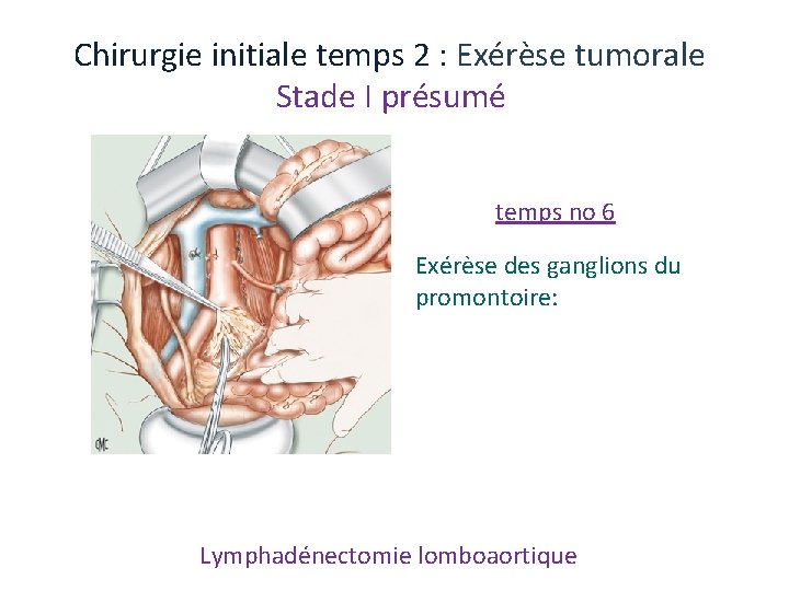 Chirurgie initiale temps 2 : Exérèse tumorale Stade I présumé temps no 6 Exérèse Chirurgie initiale temps 2 : Exérèse tumorale Stade I présumé temps no 6 Exérèse