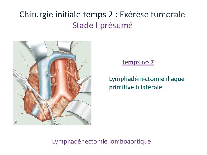 Chirurgie initiale temps 2 : Exérèse tumorale Stade I présumé temps no 7 Lymphadénectomie Chirurgie initiale temps 2 : Exérèse tumorale Stade I présumé temps no 7 Lymphadénectomie