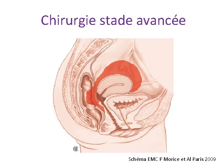 Chirurgie stade avancée Schéma EMC P Morice et Al Paris 2009 Chirurgie stade avancée Schéma EMC P Morice et Al Paris 2009