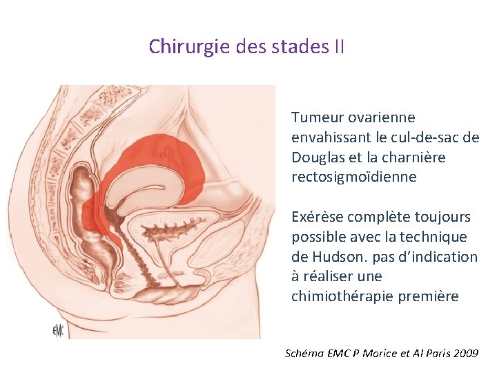 Chirurgie des stades II Tumeur ovarienne envahissant le cul‐de‐sac de Douglas et la charnière Chirurgie des stades II Tumeur ovarienne envahissant le cul‐de‐sac de Douglas et la charnière