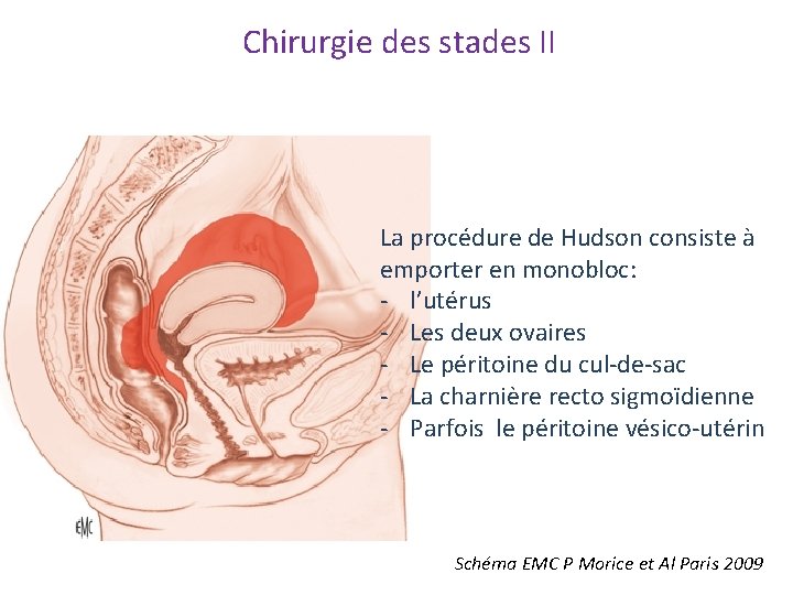 Chirurgie des stades II La procédure de Hudson consiste à emporter en monobloc: ‐ Chirurgie des stades II La procédure de Hudson consiste à emporter en monobloc: ‐