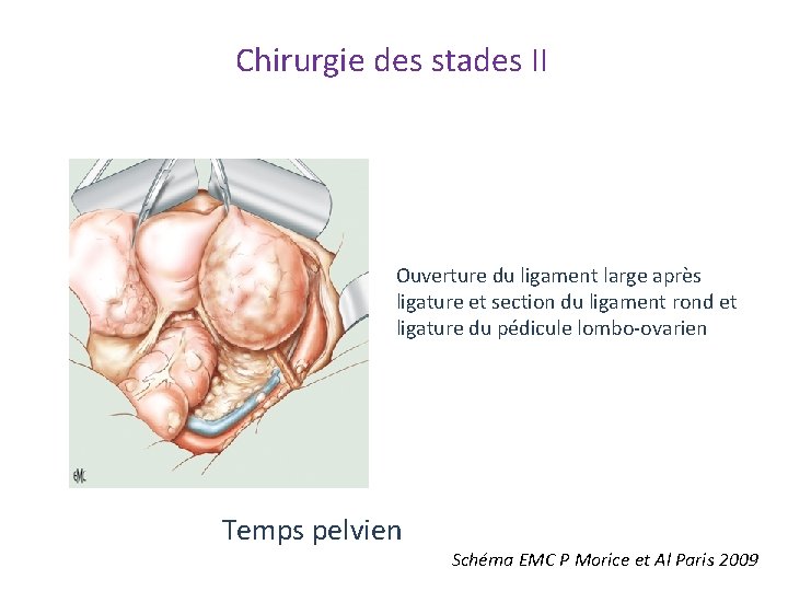 Chirurgie des stades II Ouverture du ligament large après ligature et section du ligament Chirurgie des stades II Ouverture du ligament large après ligature et section du ligament