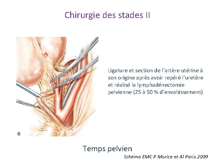 Chirurgie des stades II Ligature et section de l’artère utérine à son origine après Chirurgie des stades II Ligature et section de l’artère utérine à son origine après