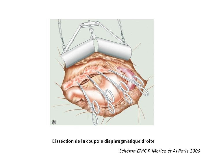 Dissection de la coupole diaphragmatique droite Schéma EMC P Morice et Al Paris 2009 Dissection de la coupole diaphragmatique droite Schéma EMC P Morice et Al Paris 2009