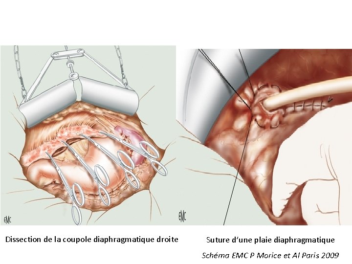 Dissection de la coupole diaphragmatique droite Suture d’une plaie diaphragmatique Schéma EMC P Morice Dissection de la coupole diaphragmatique droite Suture d’une plaie diaphragmatique Schéma EMC P Morice