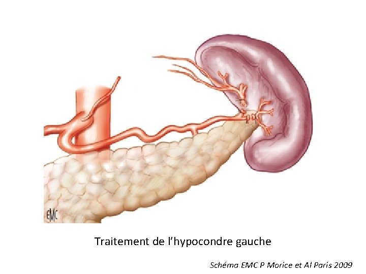 Traitement de l’hypocondre gauche Schéma EMC P Morice et Al Paris 2009 Traitement de l’hypocondre gauche Schéma EMC P Morice et Al Paris 2009