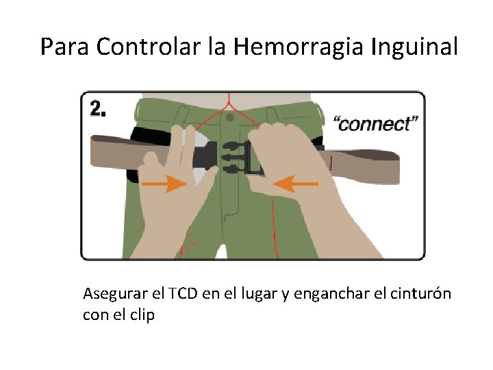 Para Controlar la Hemorragia Inguinal Asegurar el TCD en el lugar y enganchar el