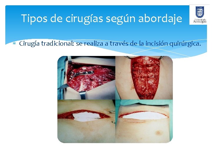 Tipos de cirugías según abordaje Cirugía tradicional: se realiza a través de la incisión