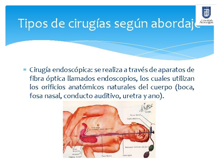 Tipos de cirugías según abordaje Cirugía endoscópica: se realiza a través de aparatos de