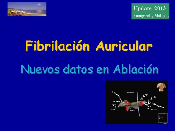 Update 20122013 Update Fuengirola, Málaga. Fibrilación Auricular Nuevos datos en Ablación 