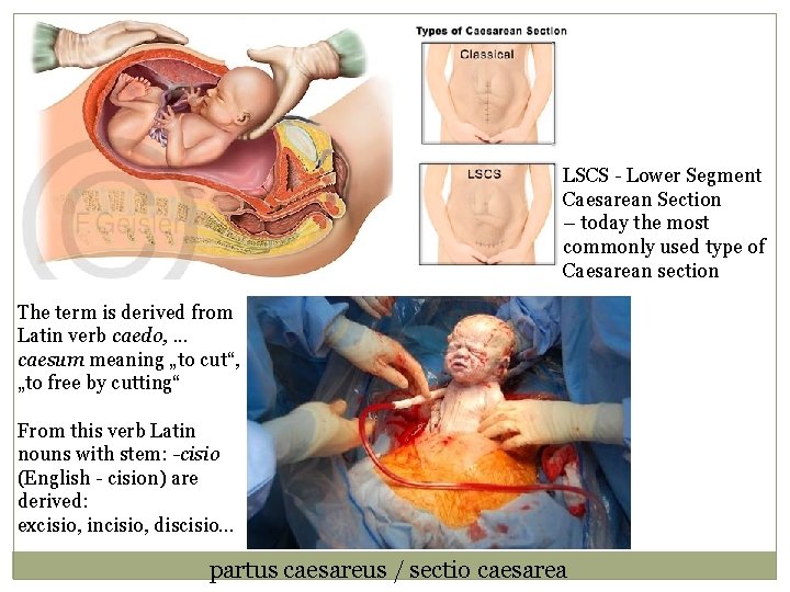 LSCS - Lower Segment Caesarean Section – today the most commonly used type of