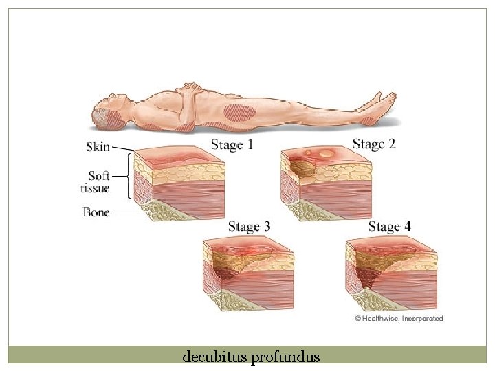 decubitus profundus 