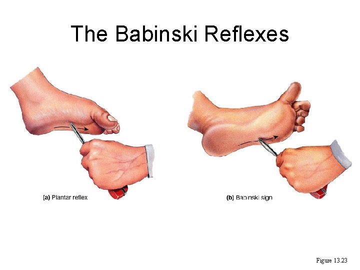 The Babinski Reflexes Figure 13. 23 