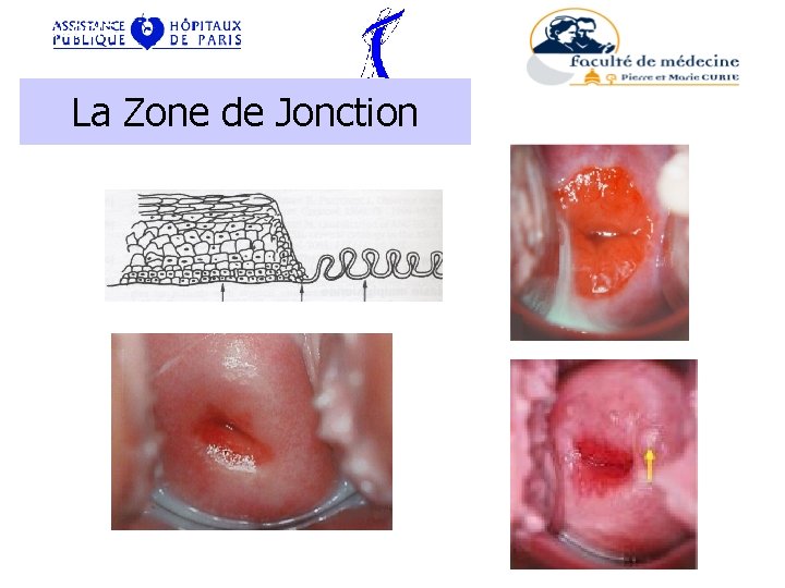 VIROLOGIE La Zone de Jonction PHYSIOPATHOLOGIE : LESIONS HPV- 