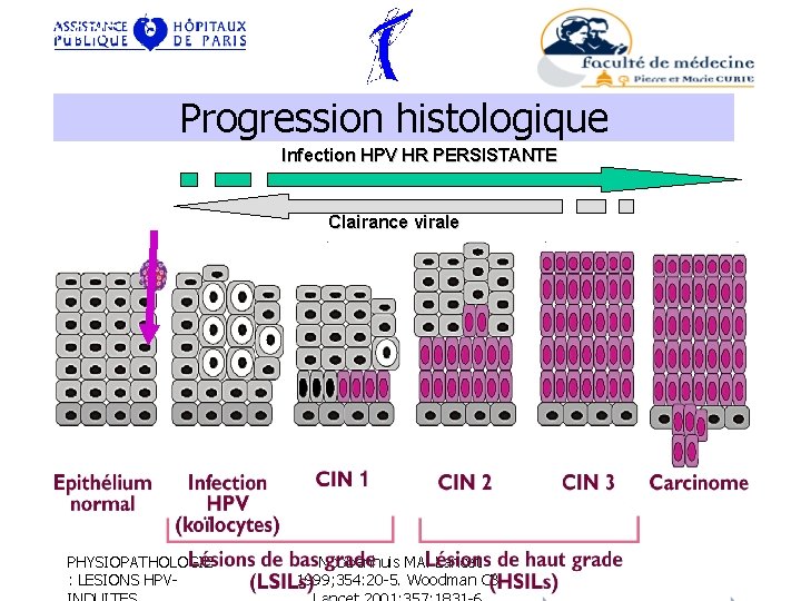 VIROLOGIE Progression histologique Infection HPV HR PERSISTANTE Clairance virale PHYSIOPATHOLOGIE : LESIONS HPV- Nobbenhuis