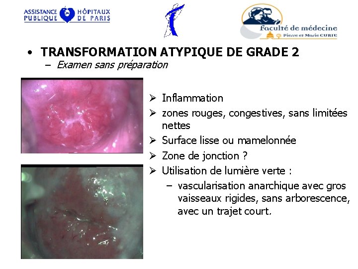  • TRANSFORMATION ATYPIQUE DE GRADE 2 – Examen sans préparation Ø Inflammation Ø