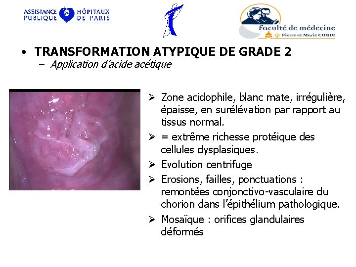  • TRANSFORMATION ATYPIQUE DE GRADE 2 – Application d’acide acétique Ø Zone acidophile,