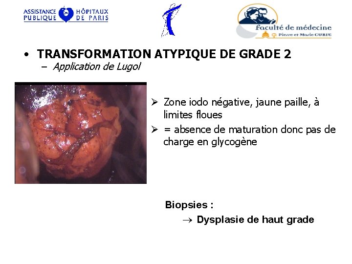  • TRANSFORMATION ATYPIQUE DE GRADE 2 – Application de Lugol Ø Zone iodo
