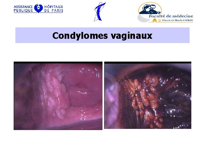 Condylomes vaginaux 