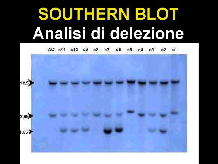 SOUTHERN BLOT Analisi di delezione 