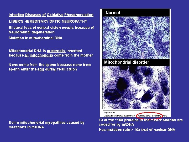 Inherited Diseases of Oxidative Phosphorylation LIBER’S HEREDITARY OPTIC NEUROPATHY Bilateral loss of central vision Inherited Diseases of Oxidative Phosphorylation LIBER’S HEREDITARY OPTIC NEUROPATHY Bilateral loss of central vision
