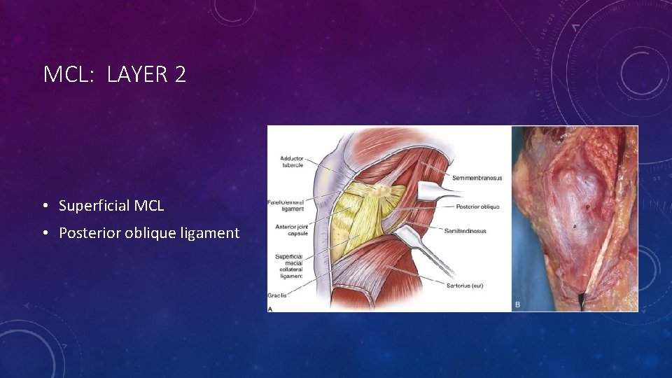 MCL: LAYER 2 • Superficial MCL • Posterior oblique ligament 