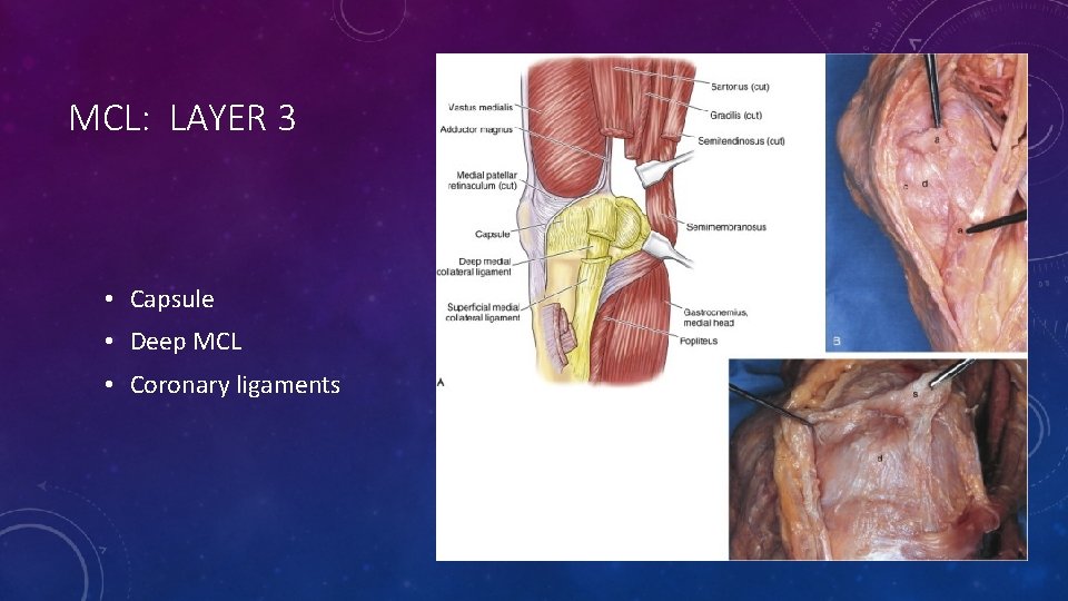 MCL: LAYER 3 • Capsule • Deep MCL • Coronary ligaments 