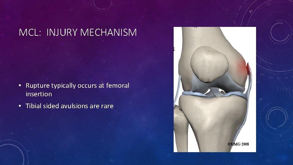 MCL: INJURY MECHANISM • Rupture typically occurs at femoral insertion • Tibial sided avulsions