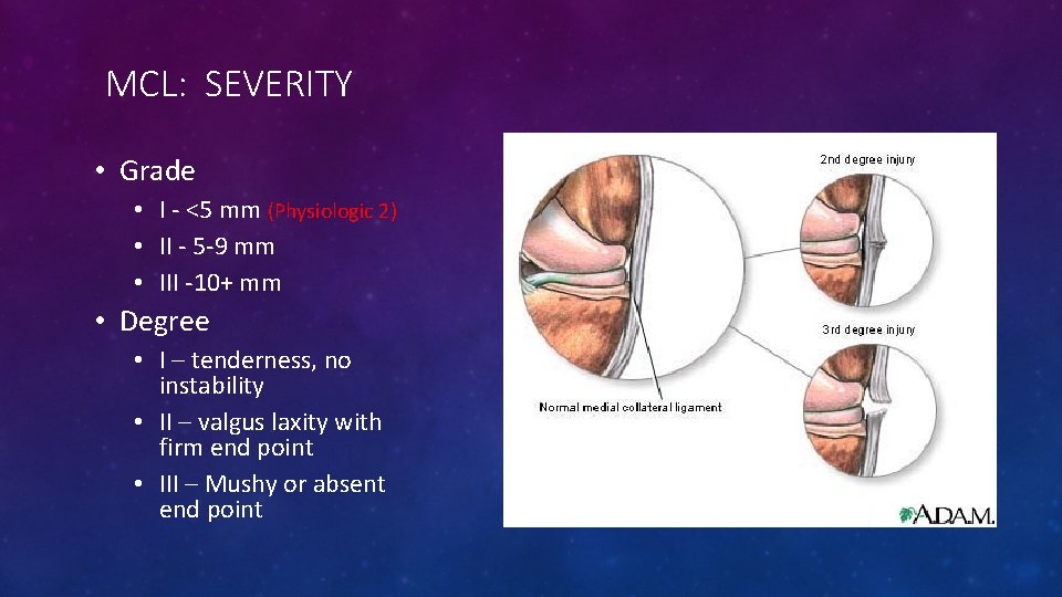 MCL: SEVERITY • Grade • I - <5 mm (Physiologic 2) • II -