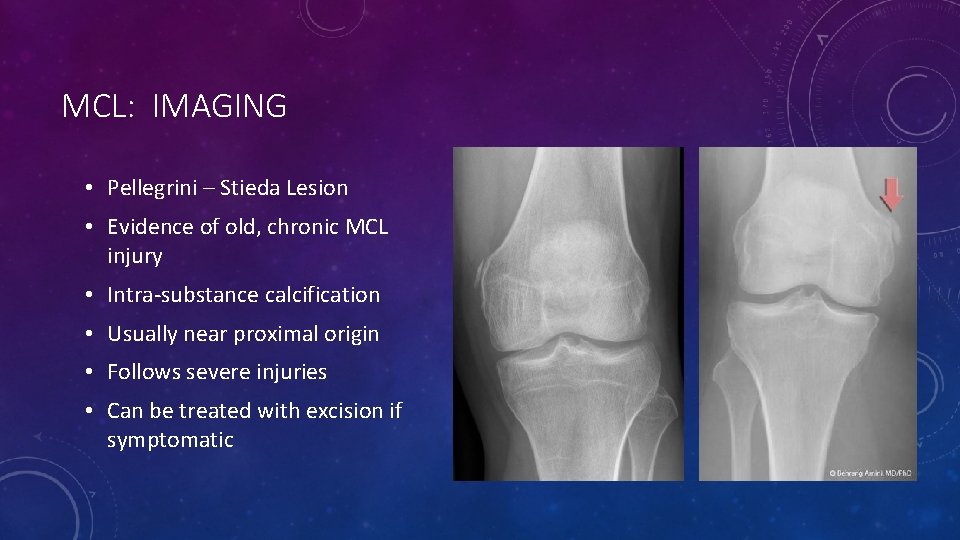 MCL: IMAGING • Pellegrini – Stieda Lesion • Evidence of old, chronic MCL injury