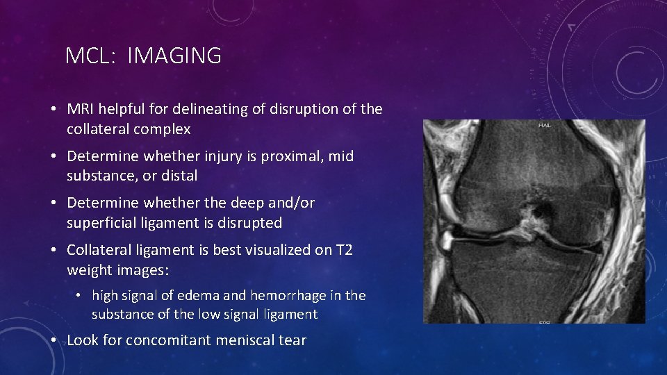 MCL: IMAGING • MRI helpful for delineating of disruption of the collateral complex •