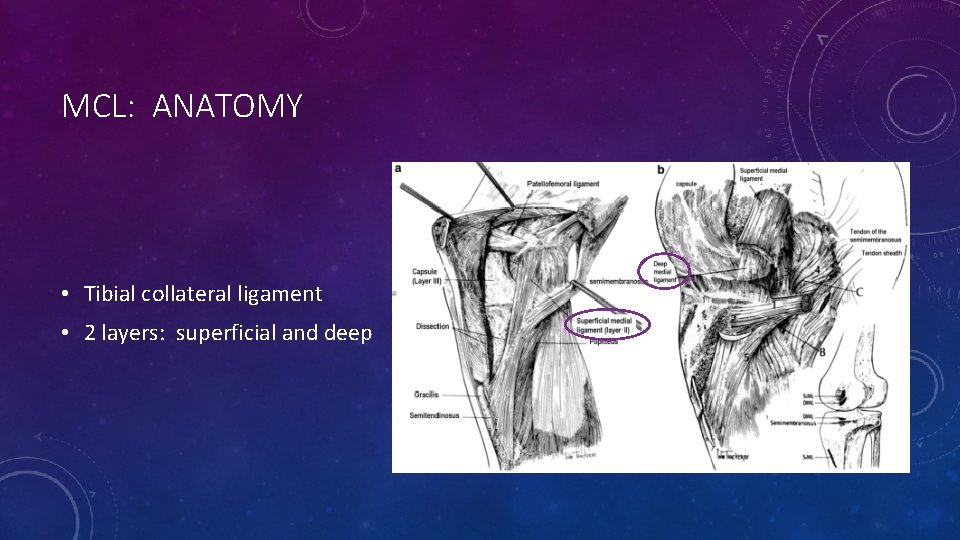 MCL: ANATOMY • Tibial collateral ligament • 2 layers: superficial and deep 