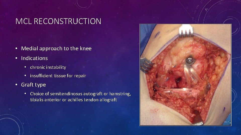 MCL RECONSTRUCTION • Medial approach to the knee • Indications • chronic instability •